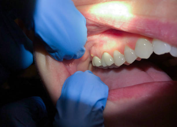 Best Emergency Wisdom Teeth Removal in West Des Moines, IA
